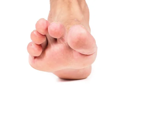 34013421_S_hammer_toe_man_foot_toes_long.jpg