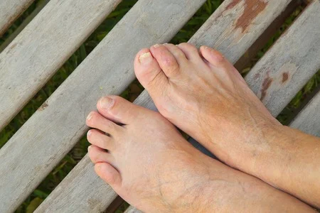 44597509_S_hammer_toe_mallet_woman.jpg