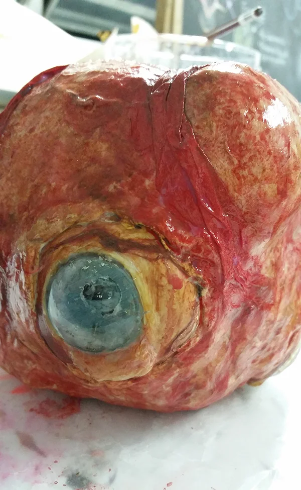 Tumor pre-op Resize.jpg