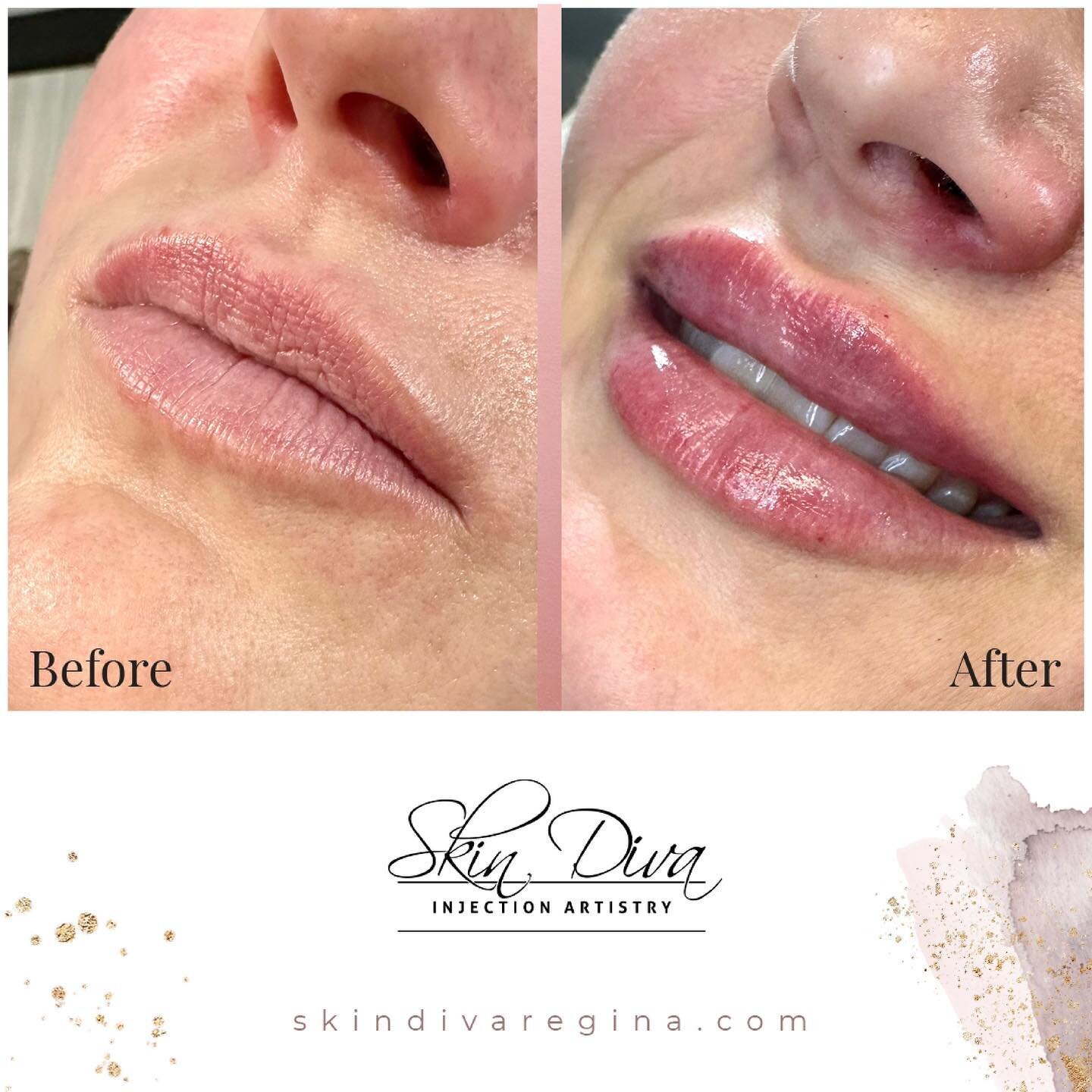 Beautifully filled lips to create hydration and subtle volume. 

#skindivainjectionartistryregina #lips #lipfiller #lipaugmentation #lipinjections #lipenhancement #lipfiller #lipenvy #liplover #lipgoals #fullips #liphydration #cosmeticinjectables #co