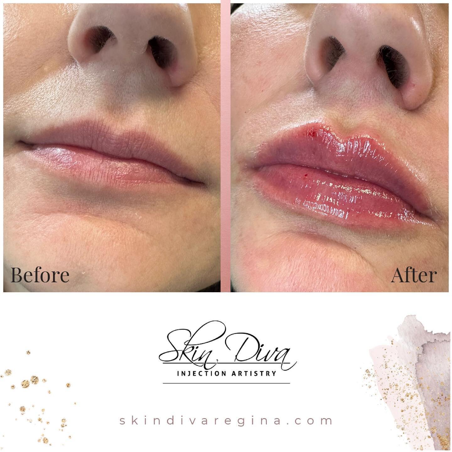 Soft rejuvenated pout for this gals birthday,Happy Birthday 🎈 

Product: RHA 2 &amp; Kiss

💉Product: RHA &amp; Kiss 
⏰Length of appointment: 60 mins
⏳Duration of product: 6-9 months
🤕Side effects: redness, swelling, potential bruising

To book an 
