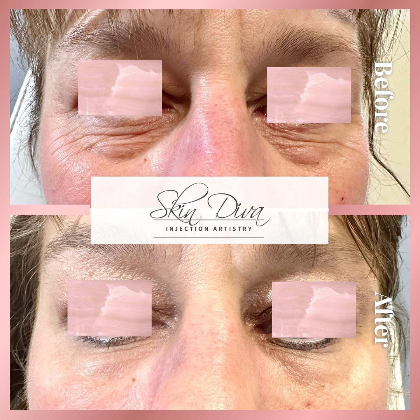 Eyes on you 👀 wow 🤩&hellip;. What a transformation for this gal. We built her structure of cheek first then using pre hydrated Redensity 2 we filled her under eyes. Softened and hydrated. 

#skindivainjectionartistryregina #eyes #teartrough #teartr