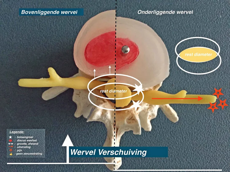 Uitstraling in het been of arm door geknelde zenuw in rug. Hernia of