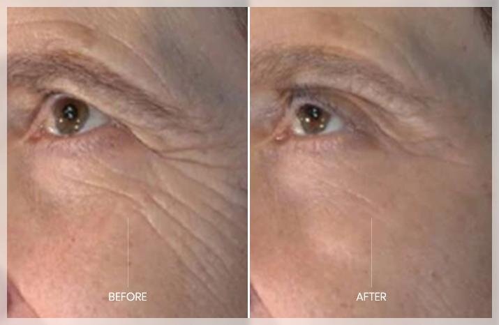 Microneedling helps reduce "crow's feet" and other wrinkles on the face.