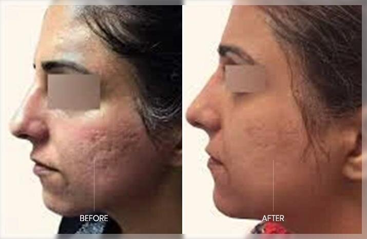 Microneedling helps reduce acne scars.