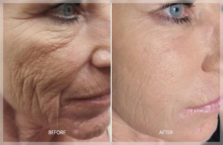 Microneedling helps minimize "laugh lines" and rejuvenates skin.