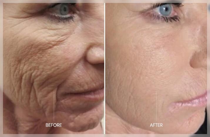 Microneedling helps reduce "laugh lines"