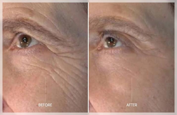 Microneedling helps reduce "crow's feet" and other wrinkles.