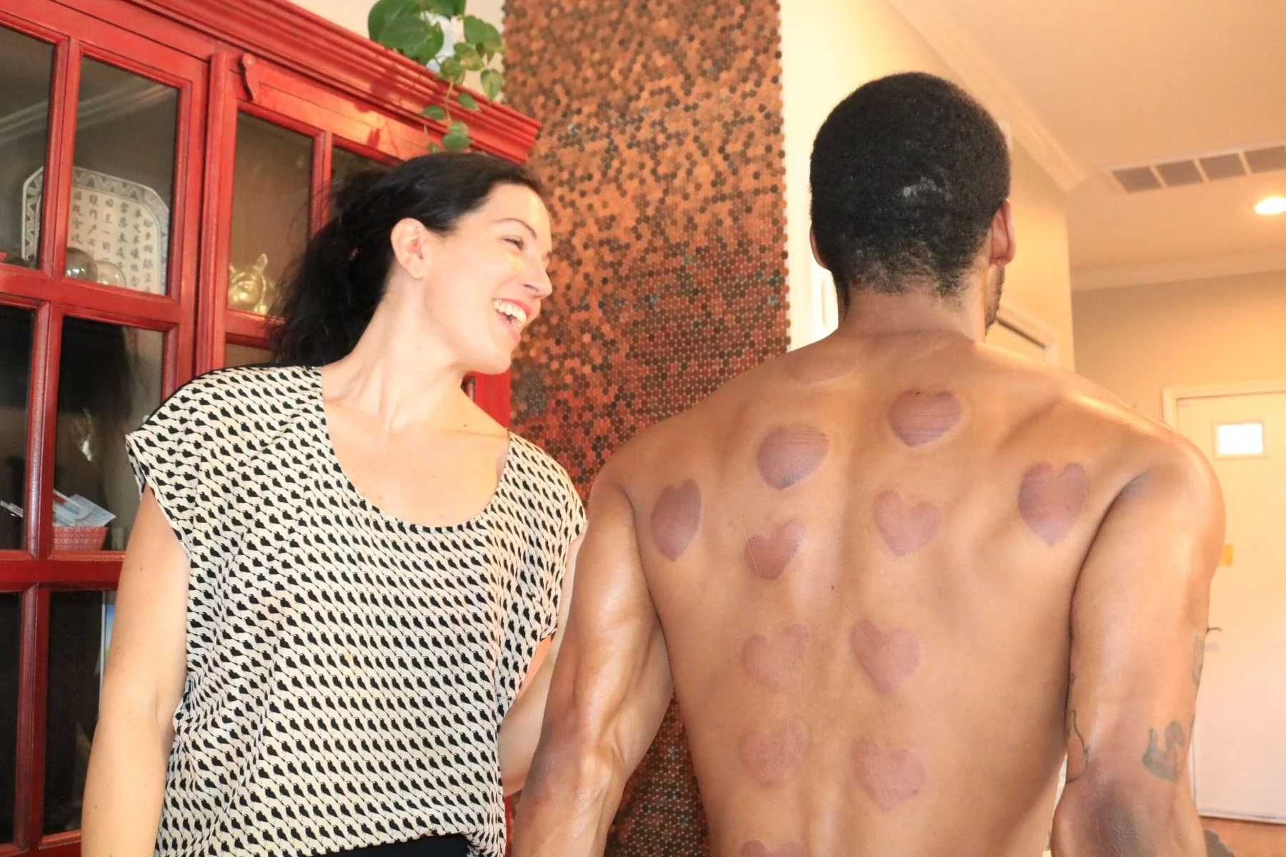  Dr Jenna Valentine Cupping Patient 