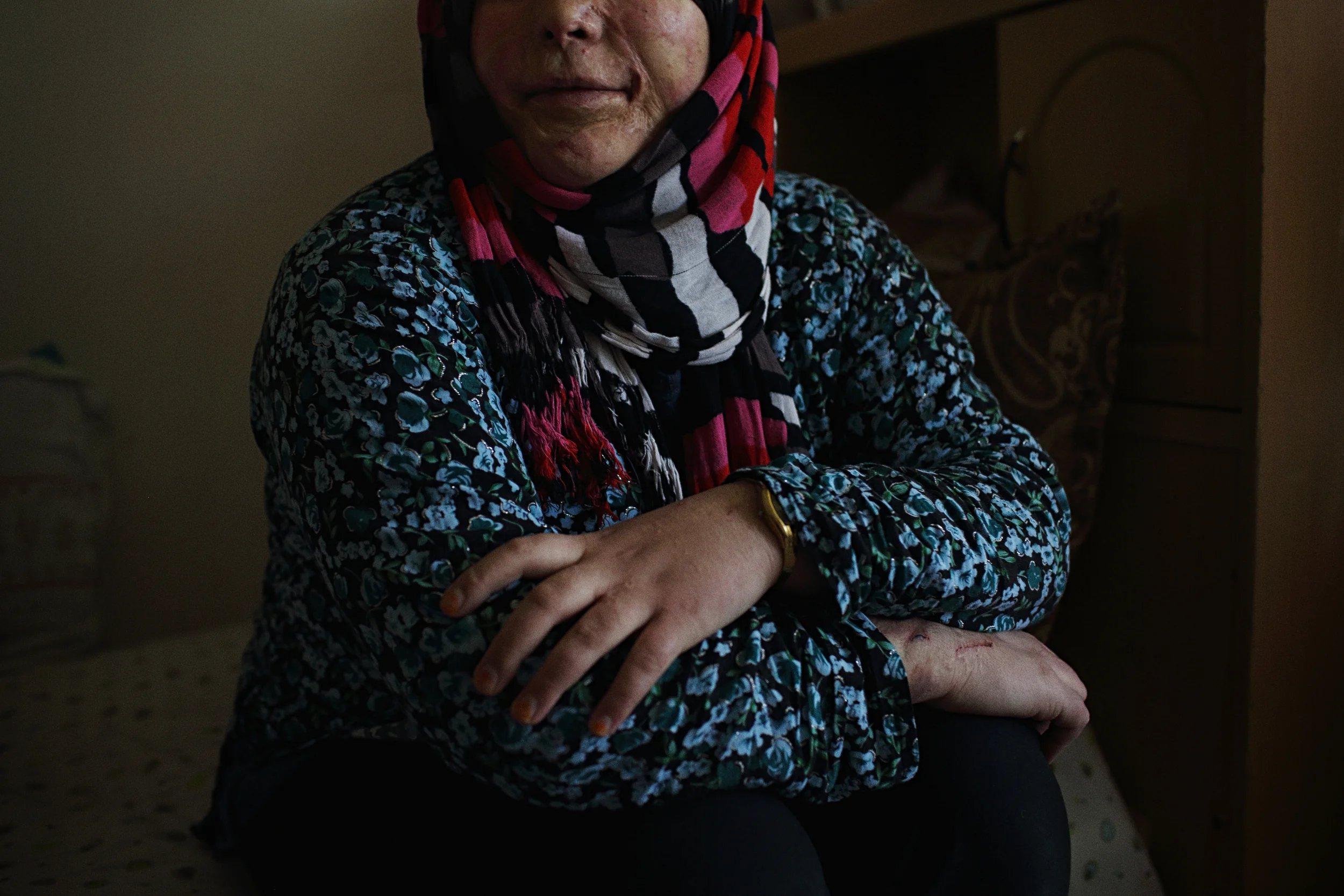  A 20-year-old woman who, after her family rejected a man for marriage, was severely disfigured when he poured acid through her window as she slept. She has since sought refuge in a women’s shelter. Kabul, November 2014. 