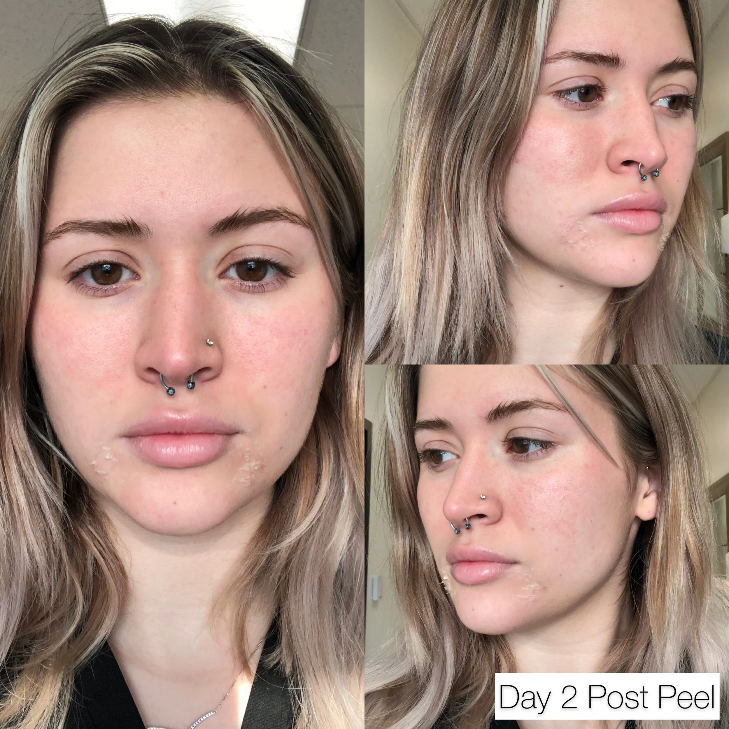 Chemical Peels — The Facebar Aesthetics and med spa