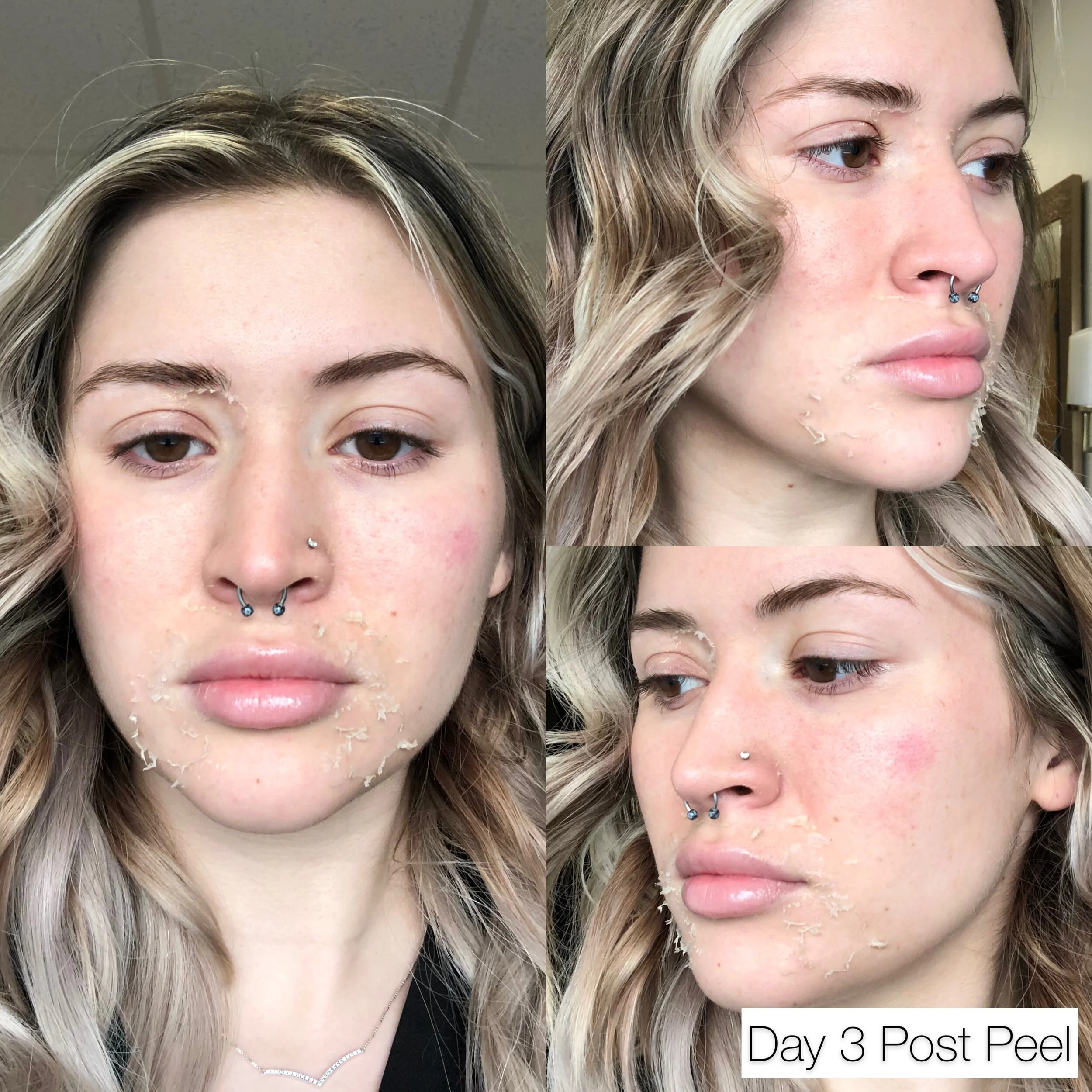 Chemical Peels — The Facebar Aesthetics and med spa