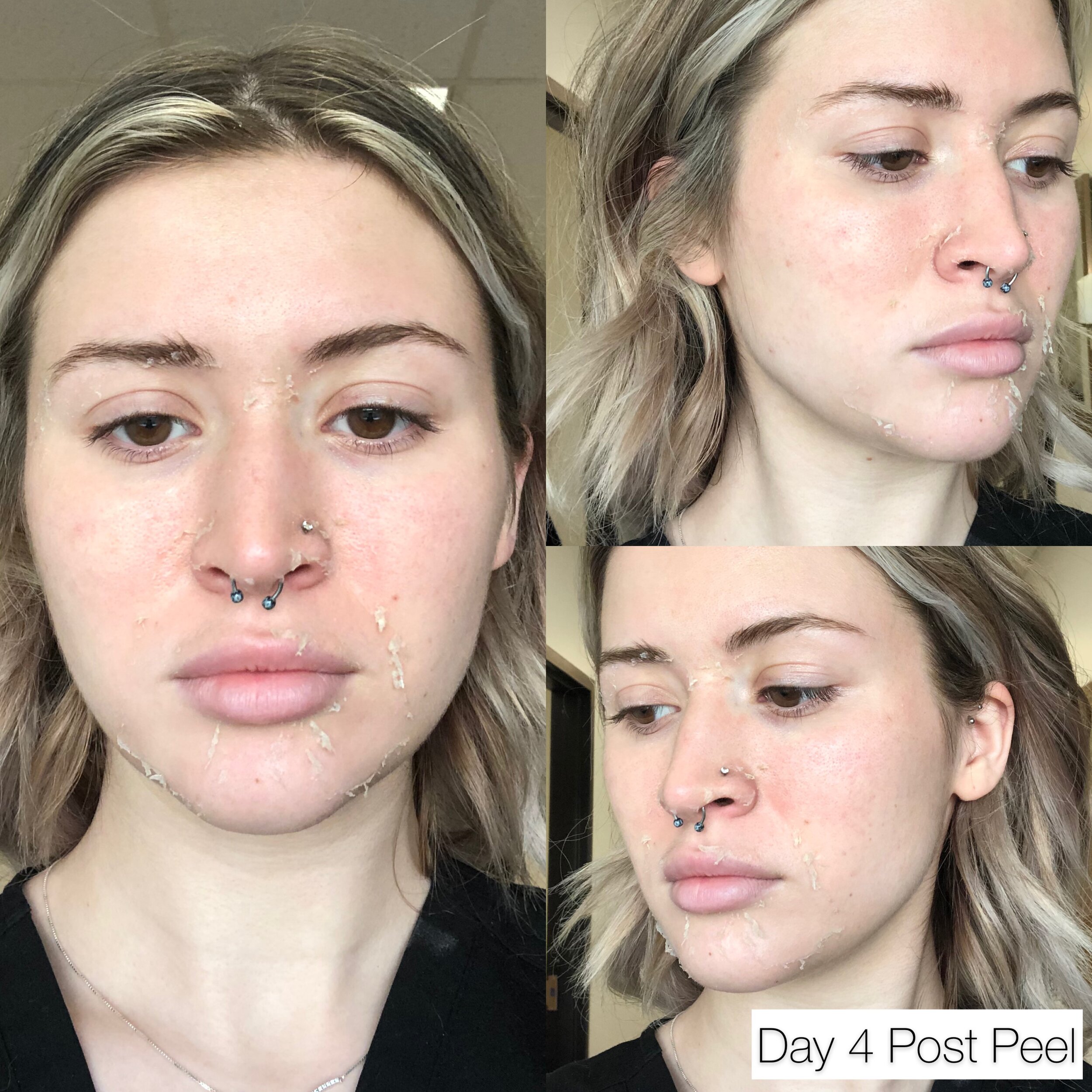 Chemical Peels — The Facebar Aesthetics and med spa