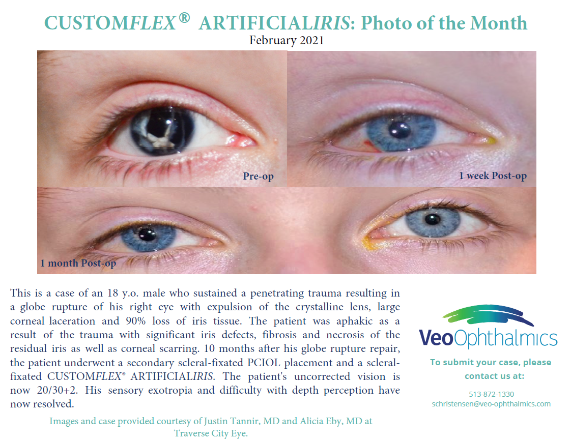 CUSTOMFLEX® ARTIFICIALIRIS Photo of the Month - February2021-2.PNG