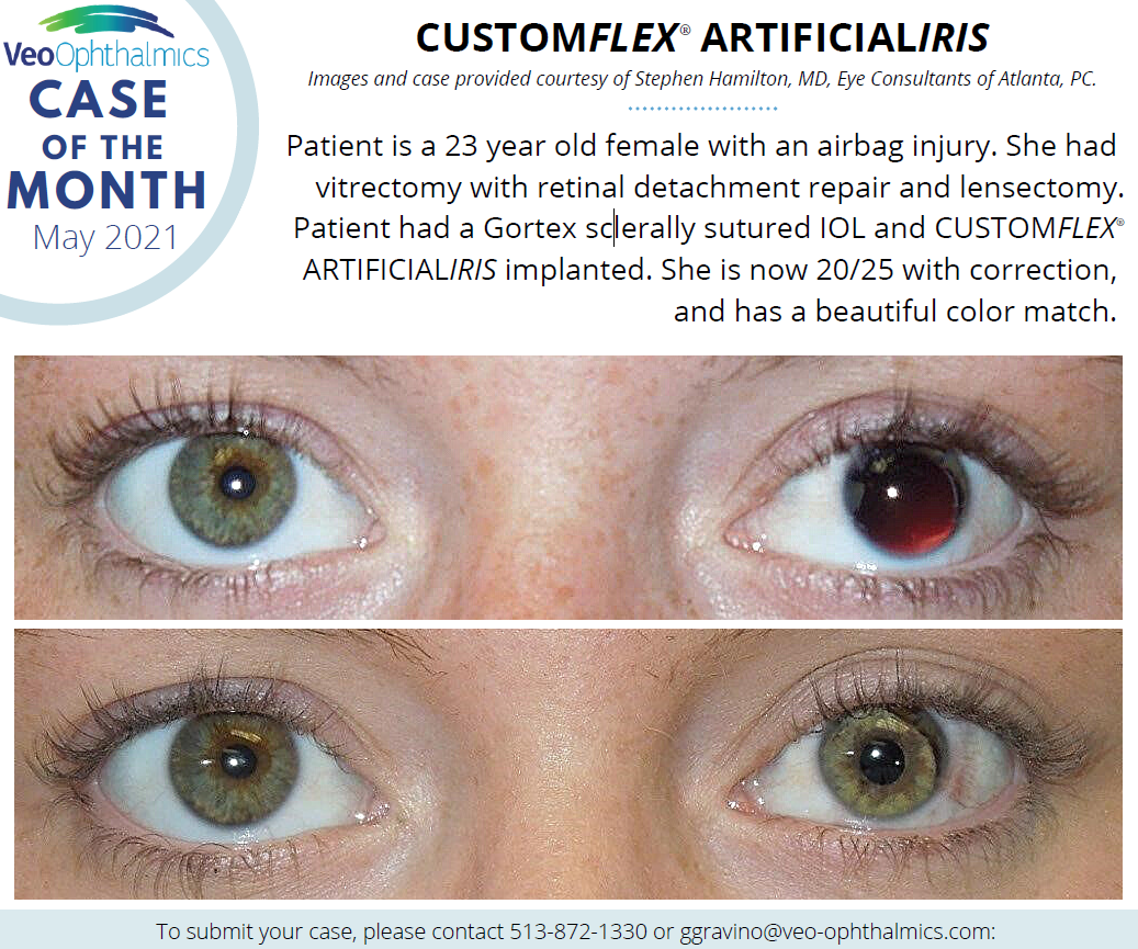 CUSTOMFLEX ARTIFICIALIRIS Case of the Month May 2021.PNG