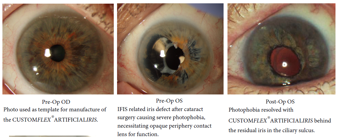 CFAI Patient Page — VEO Ophthalmics