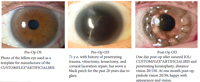 CUSTOMFLEX® ARTIFICIALIRIS — VEO Ophthalmics