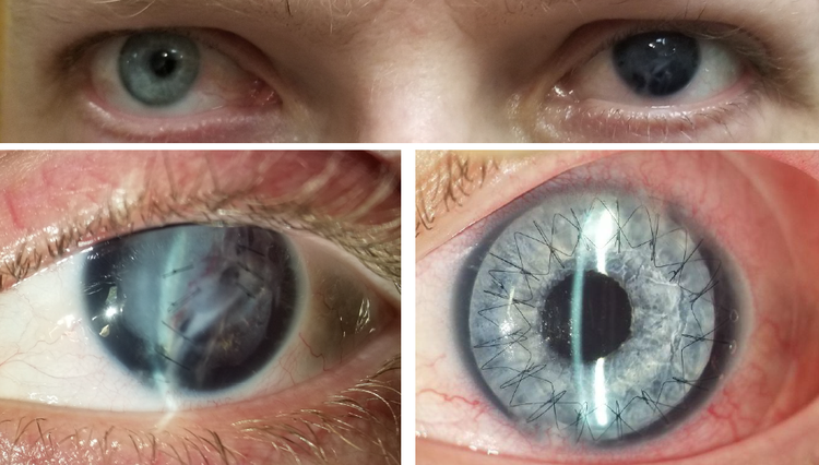 CUSTOMFLEX® ARTIFICIALIRIS — VEO Ophthalmics