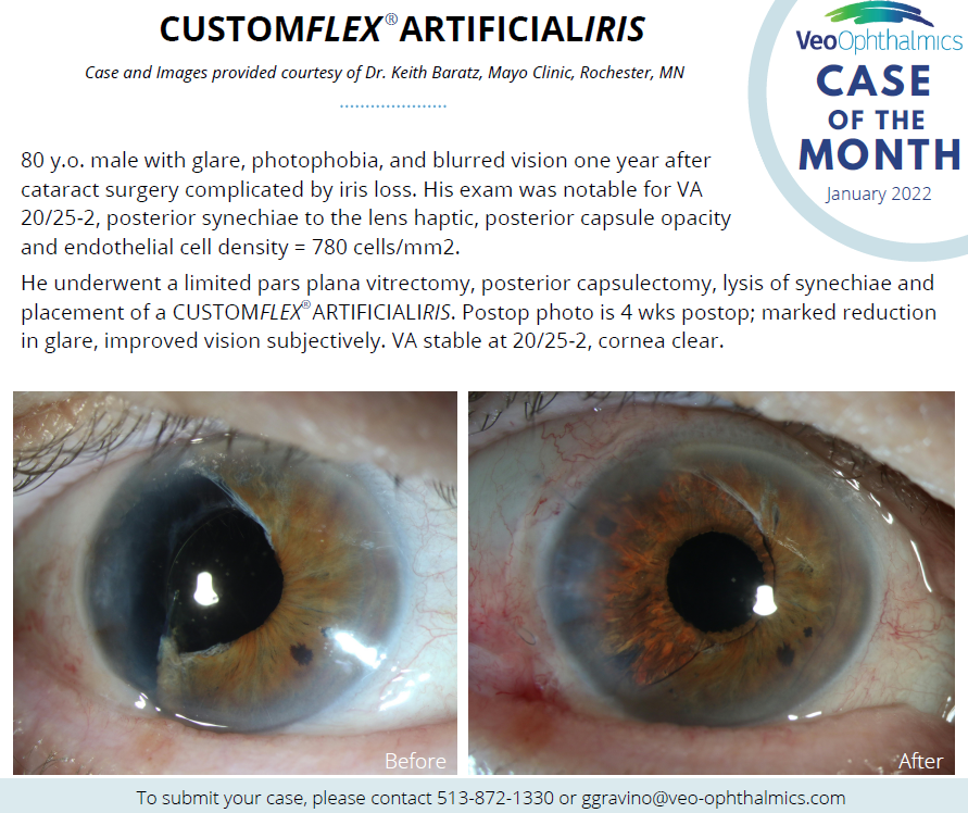 CUSTOMFLEX ARTIFICIALIRIS Case of the Month  - January 2022.PNG