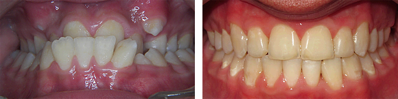 01 Before & After Orthodontics.png