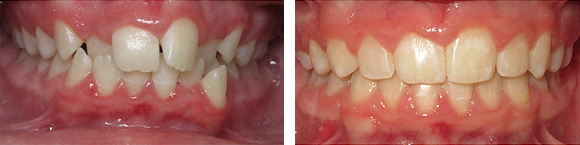 02 Before & After Orthodontics.png