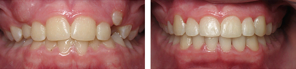 03 Before & After Orthodontics.png