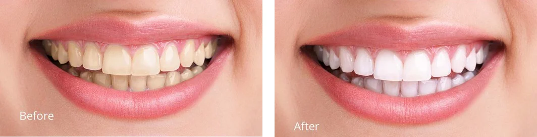 teeth whitening.jpg