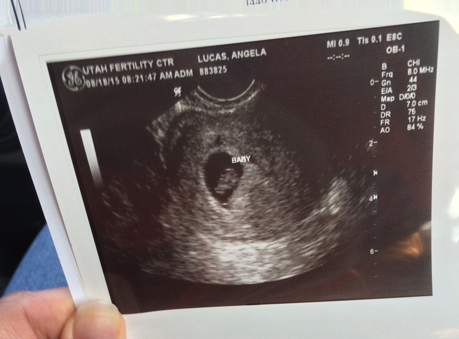 7-week ultrasound
