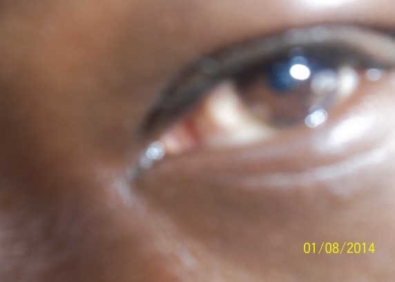 After (healthy eyes)