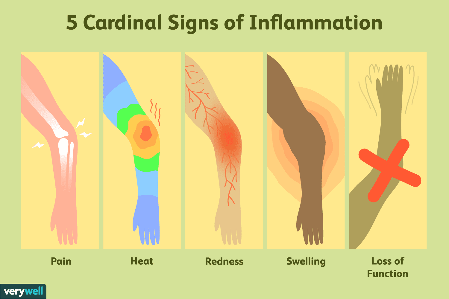 cardinal signs of inflammation.png