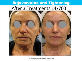 Impressive results before and after the Tixel.