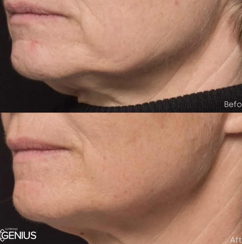 Lutronic Genius Lift: Before &amp; After