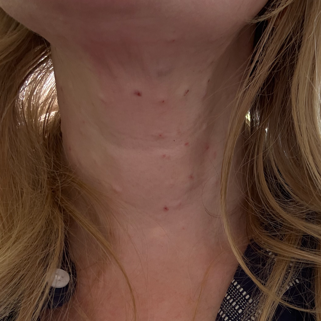 Polyneucleotides + Profhilo