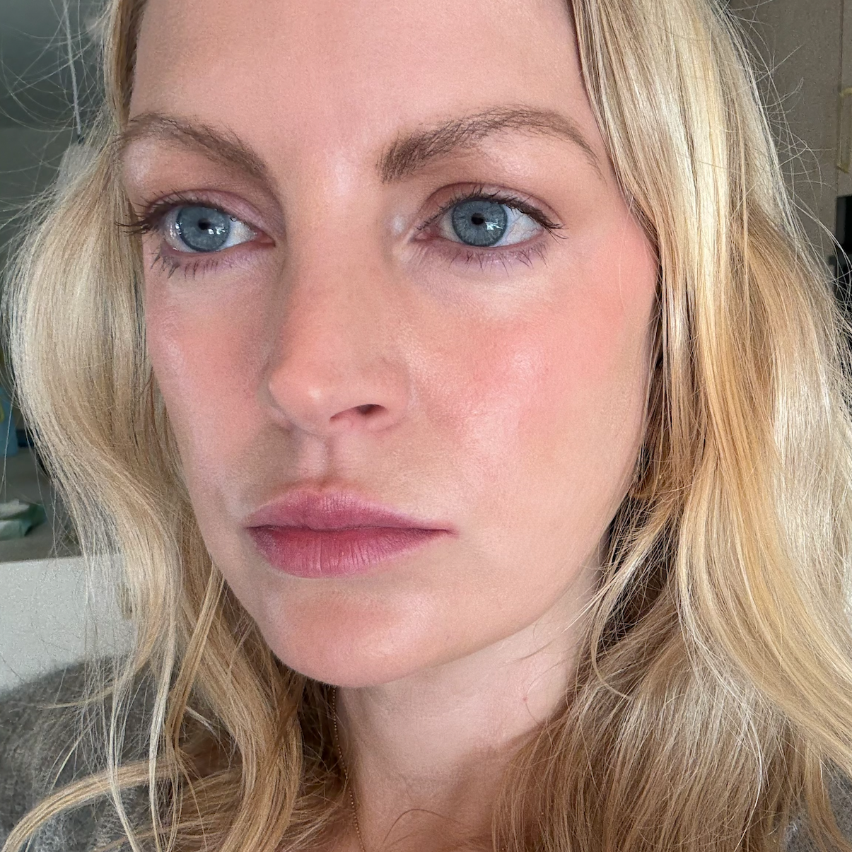 AFTER 2 Sessions of Morpheus8