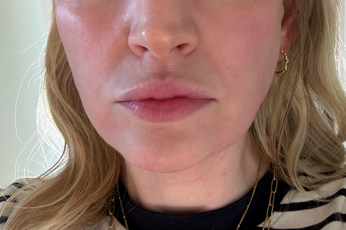 Before Profhilo Structura + Botox