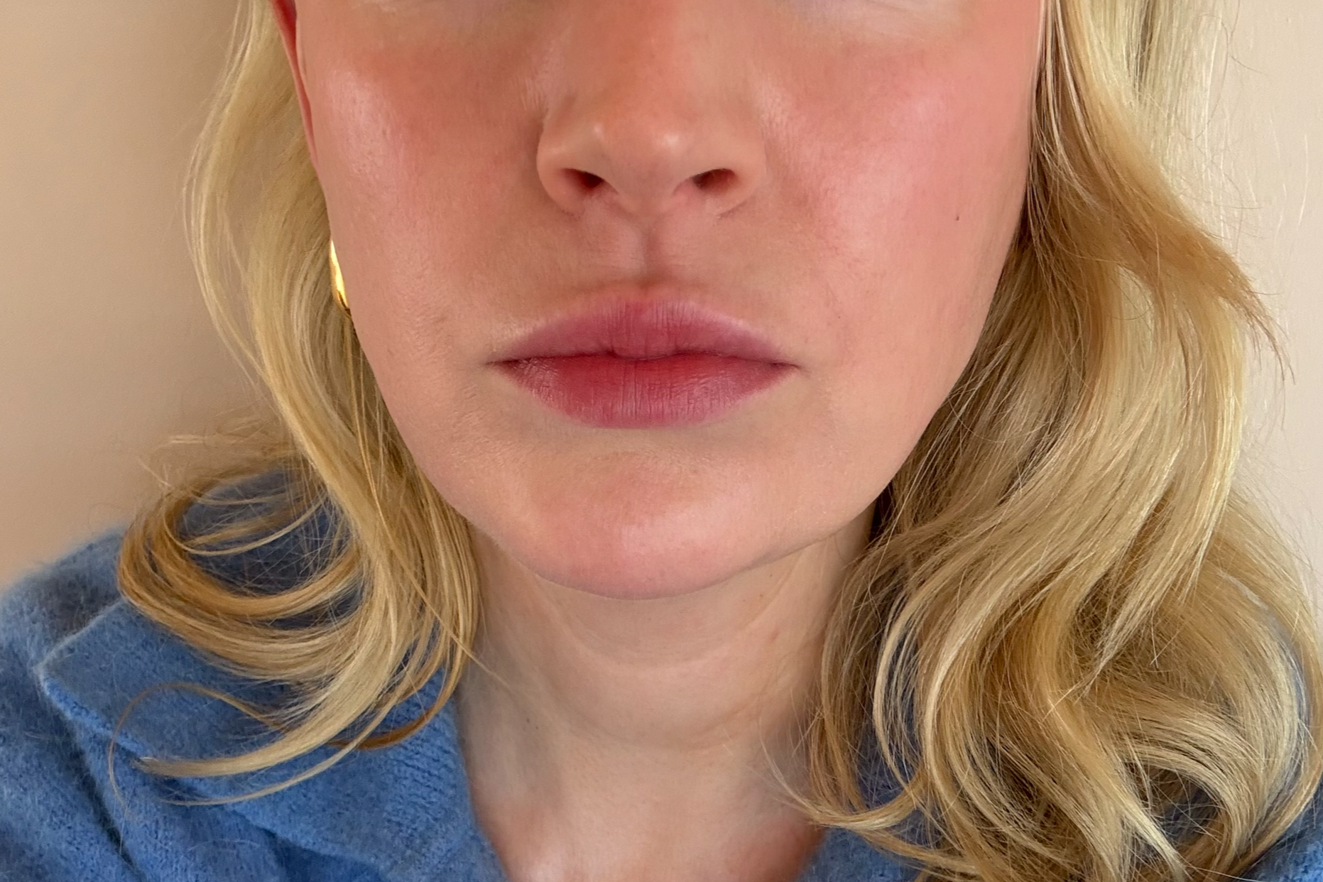 After Profhilo Structura, Botox + Profhilo