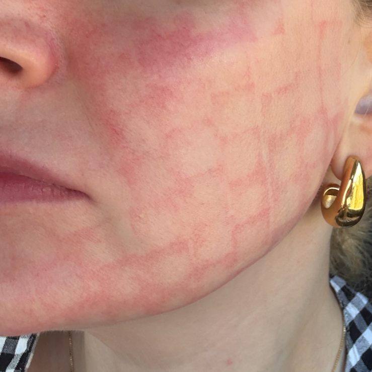 Immediately after UltraClear Laser 