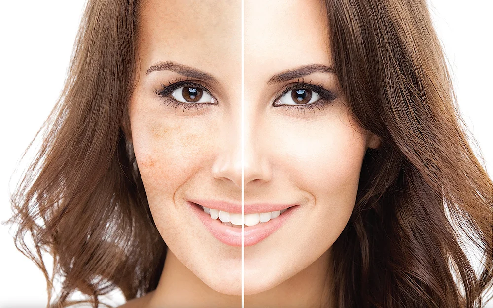 Give your skin that youthful look again with our PRP Treatment...