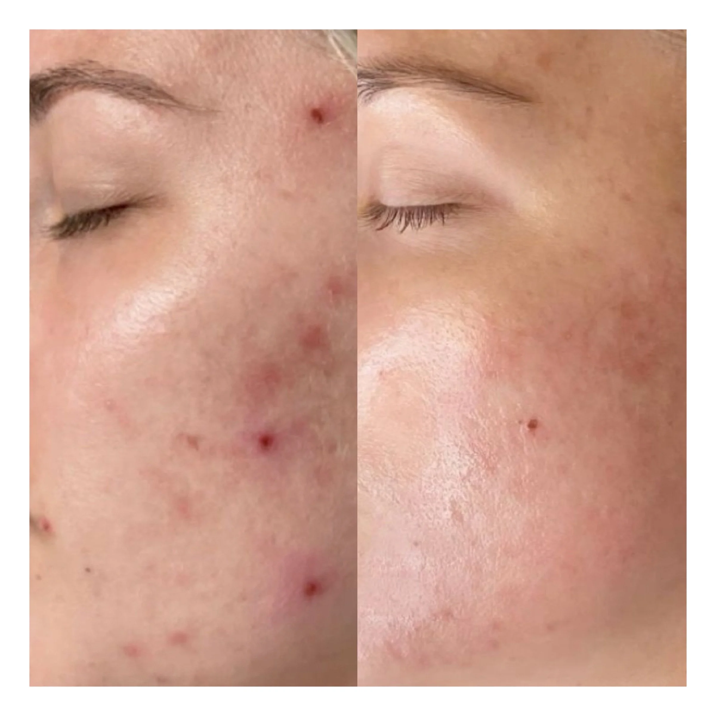 Microneedling Hamburg Ergebnis mit weniger Unreinheiten und glatterer Haut
