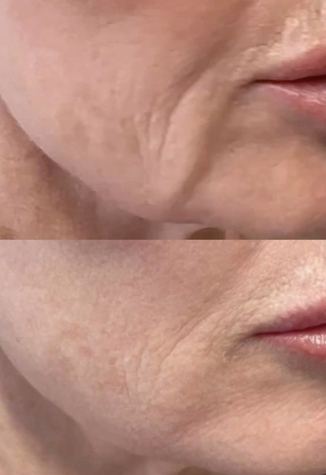 Kombination aus Microneedling und Lymphdrainage in Hamburg – sichtbar straffere und definierte Konturen