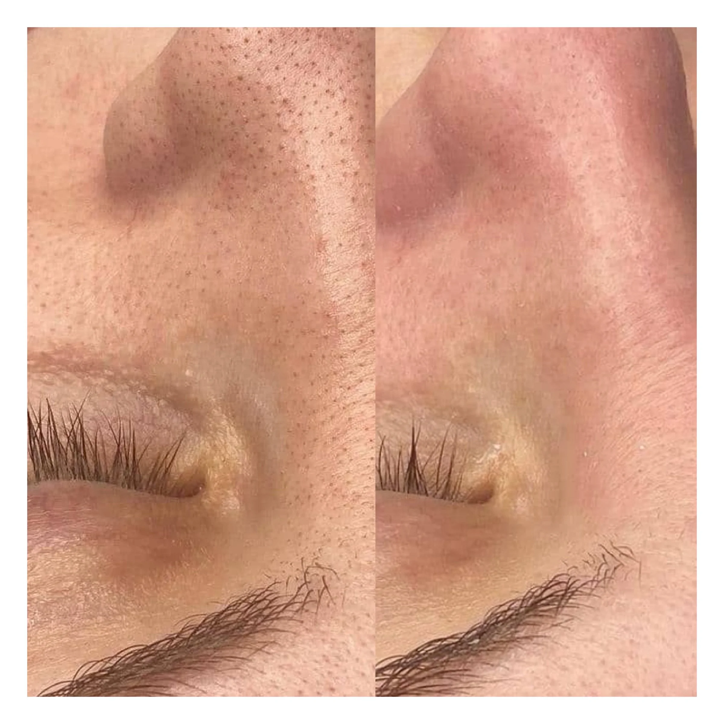Microdermabrasion Hamburg Ergebnis mit verfeinerten Poren und klarem Hautbild