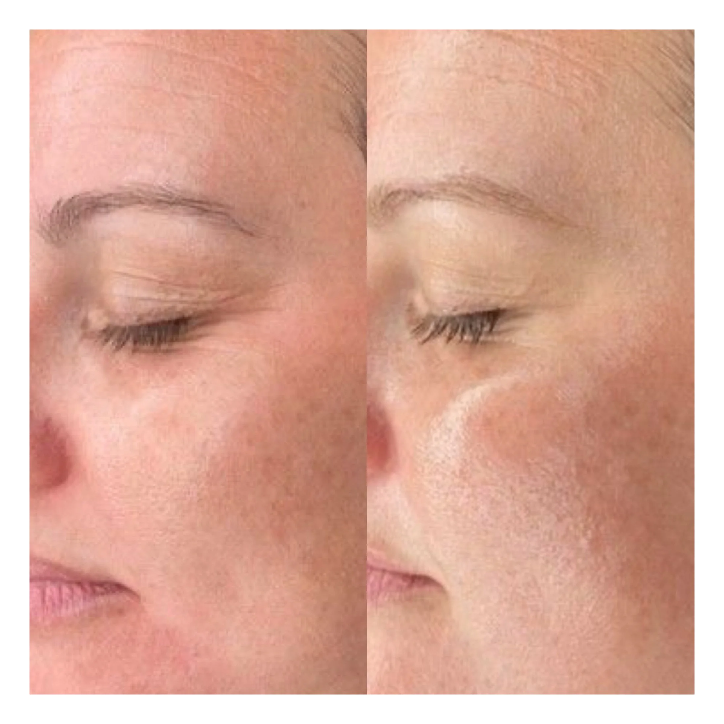 Hydrafacial Hamburg vorher nachher Ergebnis mit gereinigten Poren und strahlender Haut