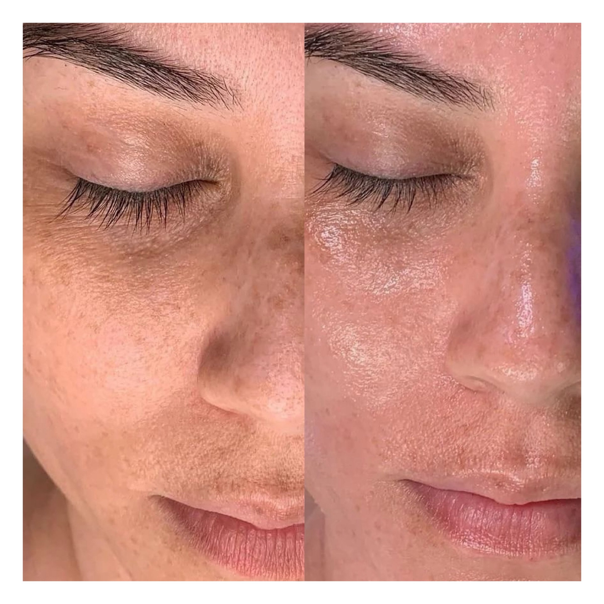 Hydrafacial Hamburg Ergebnis mit strahlender Haut nach Behandlung
