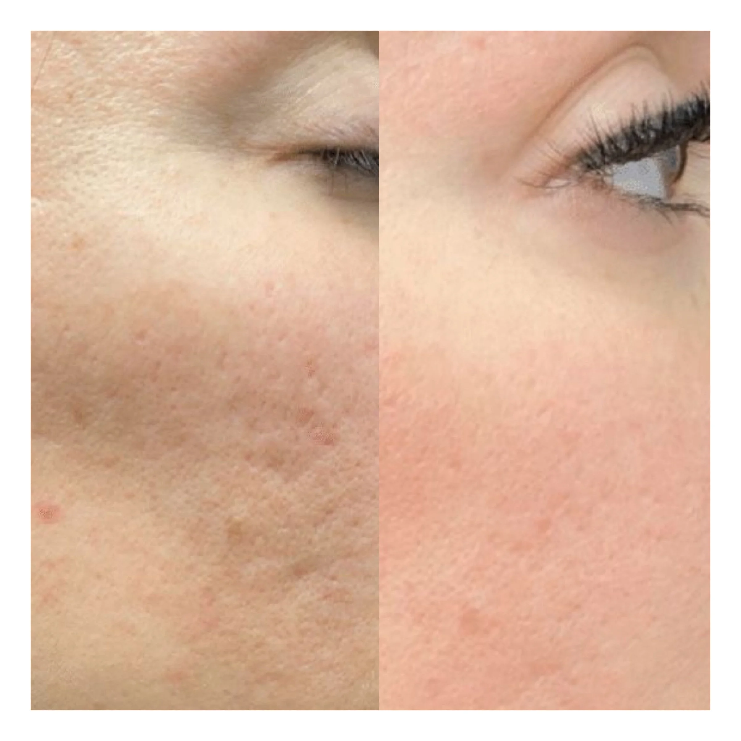 Aknenarben Gesicht nach Microneedling glattere Hautstruktur Ergebnis