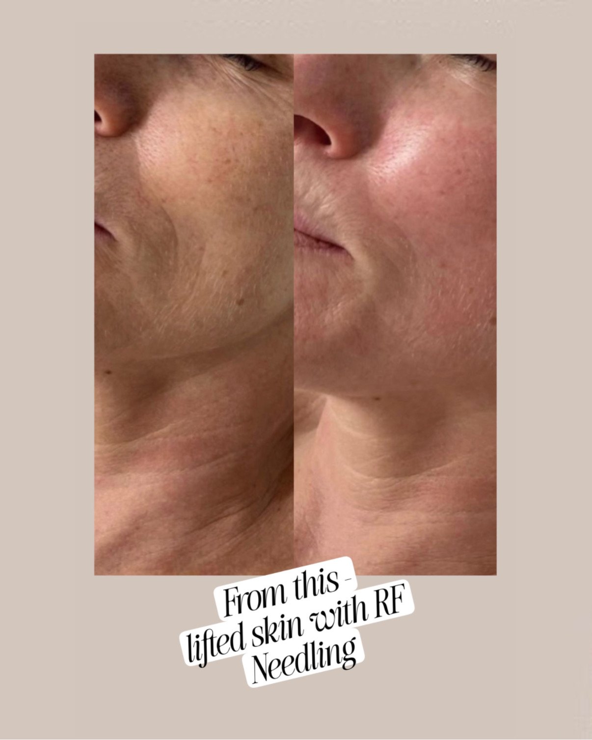 RF Microneedling Hamburg Vorher-Nachher – maximale Hautstraffung und Regeneration nach einer Behandlungskur bei Elena Antonova Skin Health.