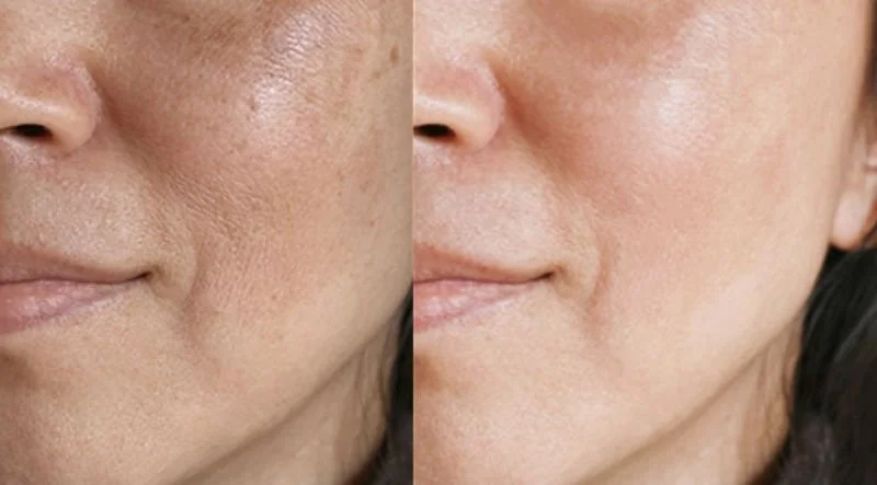 Microdermabrasion Kur Hamburg