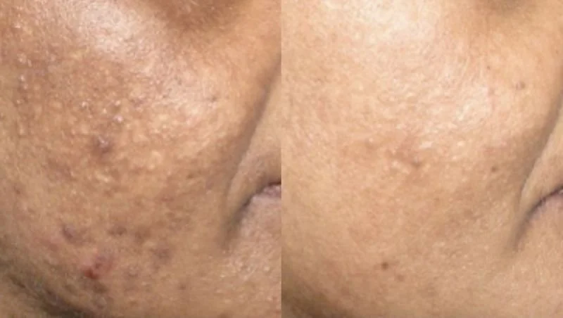 Microdermabrasion Kur Hamburg