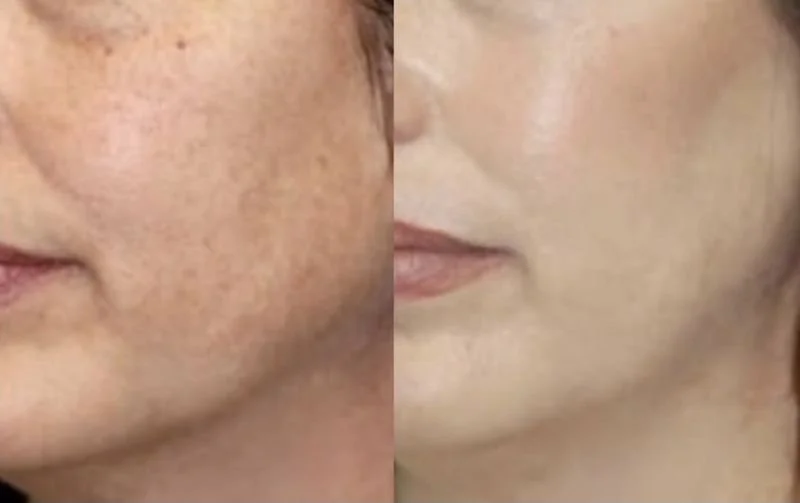 Microdermabrasion Kur Hamburg