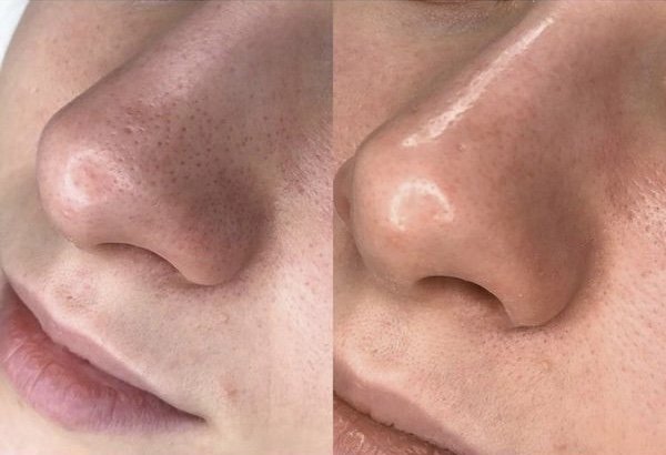 hydrafacial hamburg