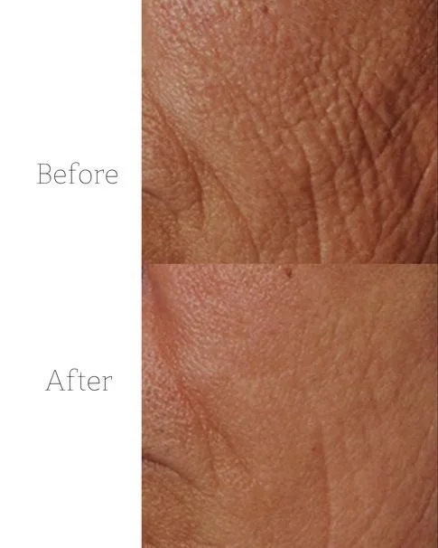 Microneedling in Hamburg Jungfernstieg – Ihr Weg zu schöner Haut